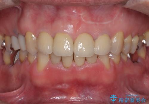 前歯4本のセラミック治療|抜歯即時インプラント+歯根端切除術で機能と美しさを回復の治療後