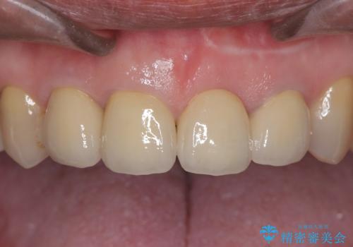 前歯4本のセラミック治療|抜歯即時インプラント+歯根端切除術で機能と美しさを回復の治療後