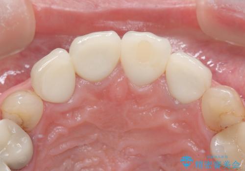 前歯4本のセラミック治療|抜歯即時インプラント+歯根端切除術で機能と美しさを回復の治療後