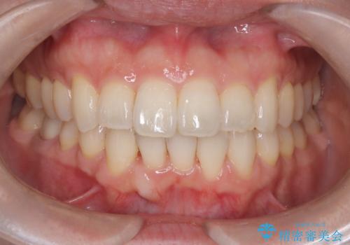 ワイヤー矯正で前歯のデコボコを改善|下顎前歯1本抜歯でバランスの良い歯並びへの治療後