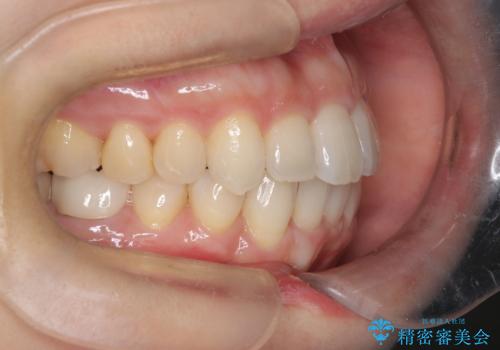 ワイヤー矯正で前歯のデコボコを改善|下顎前歯1本抜歯でバランスの良い歯並びへの治療後