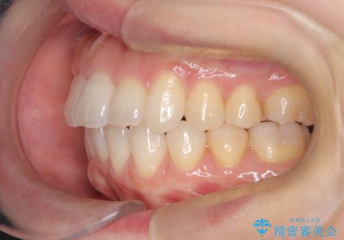 ワイヤー矯正で前歯のデコボコを改善|下顎前歯1本抜歯でバランスの良い歯並びへの治療後