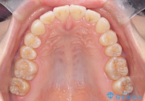 ワイヤー矯正で前歯のデコボコを改善|下顎前歯1本抜歯でバランスの良い歯並びへの治療後