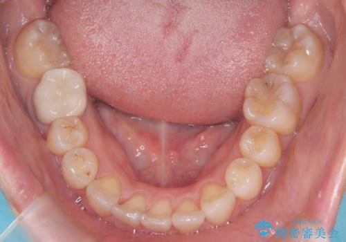 ワイヤー矯正で前歯のデコボコを改善|下顎前歯1本抜歯でバランスの良い歯並びへの治療後