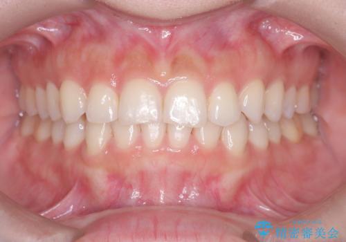 前歯のガタガタをインビザラインで改善|IPRと遠心移動でスムーズな歯並びへの治療後