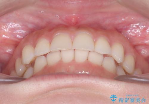 前歯のガタガタをインビザラインで改善|IPRと遠心移動でスムーズな歯並びへの治療後