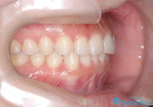 前歯のガタガタをインビザラインで改善|IPRと遠心移動でスムーズな歯並びへの治療後