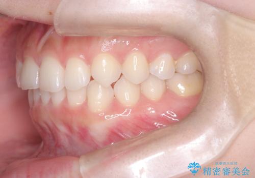 前歯のガタガタをインビザラインで改善|IPRと遠心移動でスムーズな歯並びへの治療後