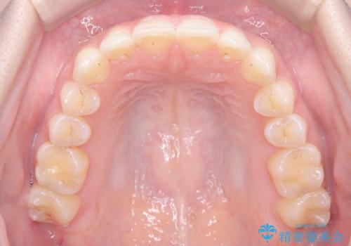 前歯のガタガタをインビザラインで改善|IPRと遠心移動でスムーズな歯並びへの治療後