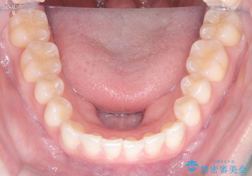 前歯のガタガタをインビザラインで改善|IPRと遠心移動でスムーズな歯並びへの治療後