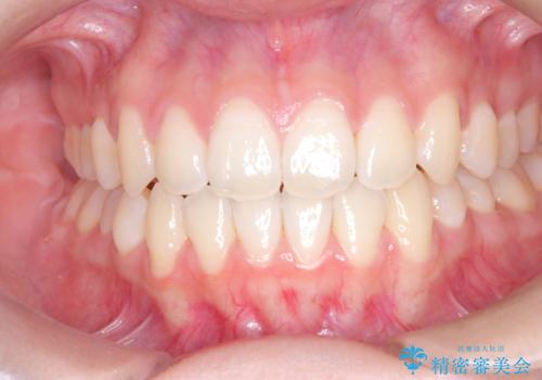 右上小臼歯の捻転を改善|インビザラインと部分ワイヤー矯正のコンビネーション治療の治療後