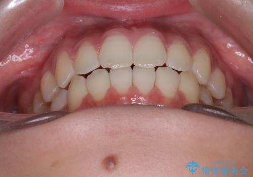 右上小臼歯の捻転を改善|インビザラインと部分ワイヤー矯正のコンビネーション治療の治療後