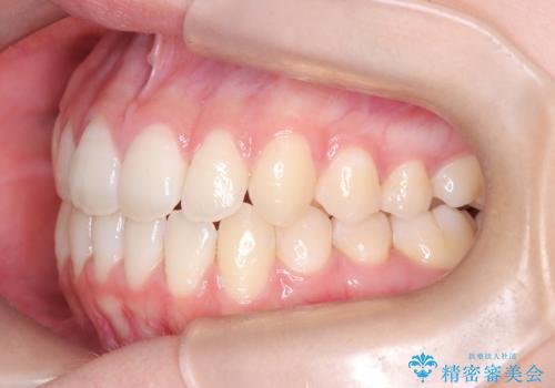 右上小臼歯の捻転を改善|インビザラインと部分ワイヤー矯正のコンビネーション治療の治療後