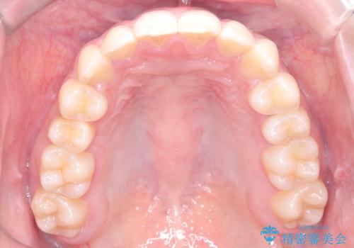右上小臼歯の捻転を改善|インビザラインと部分ワイヤー矯正のコンビネーション治療の治療後