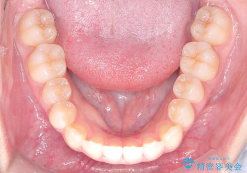 右上小臼歯の捻転を改善|インビザラインと部分ワイヤー矯正のコンビネーション治療の治療後