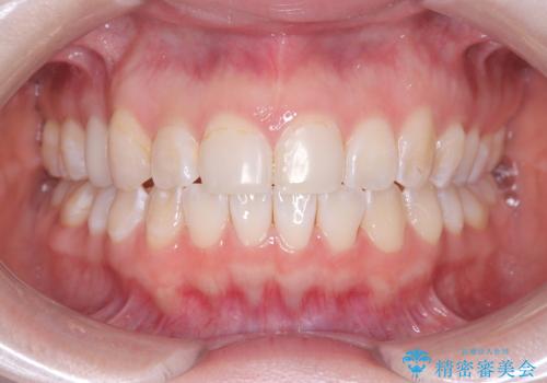「フルリンガル矯正|アンカースクリューを活用し正中を整えた症例」の症例 治療後
