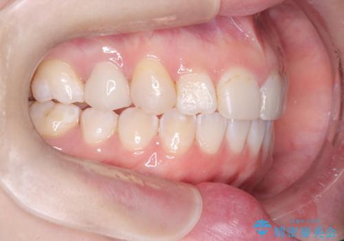 「フルリンガル矯正|アンカースクリューを活用し正中を整えた症例」の治療後