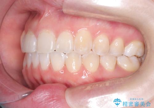 「フルリンガル矯正|アンカースクリューを活用し正中を整えた症例」の治療後