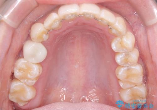 「フルリンガル矯正|アンカースクリューを活用し正中を整えた症例」の治療後