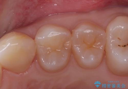 「セラミックインレーで虫歯治療|精密な適合で再発リスクを軽減」の症例 治療前