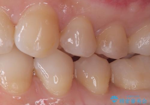 「セラミックインレーで虫歯治療|精密な適合で再発リスクを軽減」の治療前