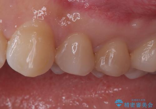 「セラミックインレーで虫歯治療|精密な適合で再発リスクを軽減」の治療前