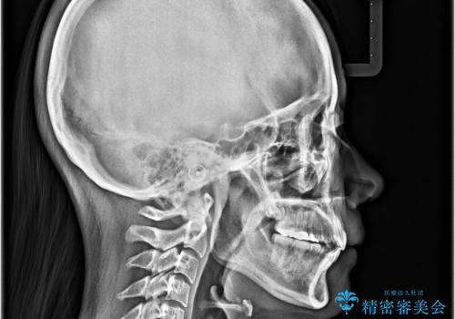 口元の突出感を改善したい。リンガルアーチを併用した抜歯矯正の治療後