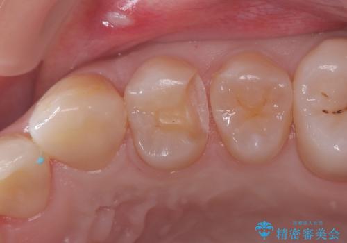 「セラミックインレーで虫歯治療|精密な適合で再発リスクを軽減」