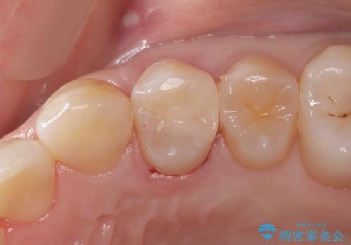 「セラミックインレーで虫歯治療|精密な適合で再発リスクを軽減」の症例 治療後