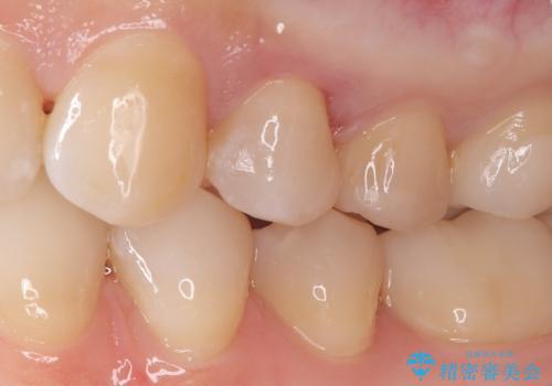 「セラミックインレーで虫歯治療|精密な適合で再発リスクを軽減」の治療後