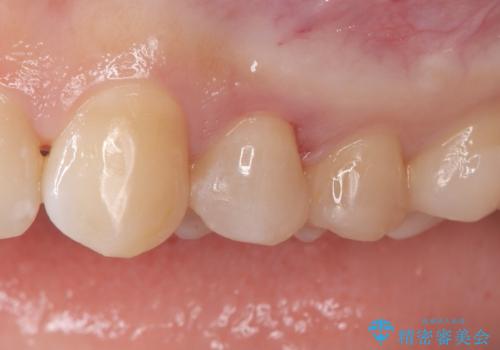 「セラミックインレーで虫歯治療|精密な適合で再発リスクを軽減」の治療後