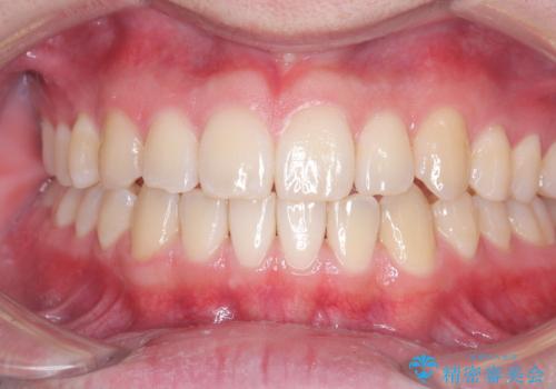 「インビザラインで八重歯をきれいに改善|遠心移動とIPRでバランスの良い歯並びへ」の治療後