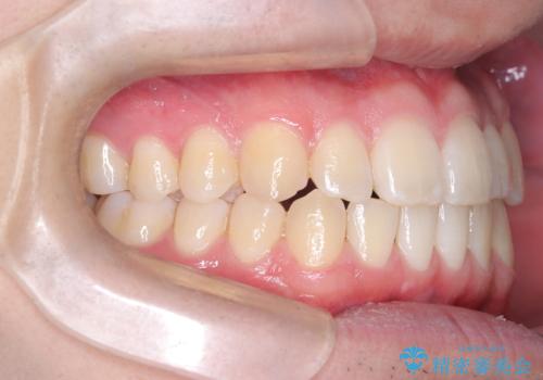 「インビザラインで八重歯をきれいに改善|遠心移動とIPRでバランスの良い歯並びへ」の治療後