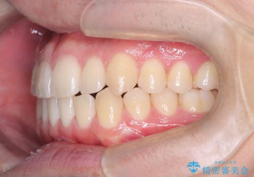 「インビザラインで八重歯をきれいに改善|遠心移動とIPRでバランスの良い歯並びへ」の治療後