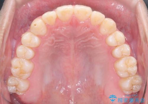 「インビザラインで八重歯をきれいに改善|遠心移動とIPRでバランスの良い歯並びへ」の治療後