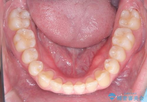 「インビザラインで八重歯をきれいに改善|遠心移動とIPRでバランスの良い歯並びへ」の治療後