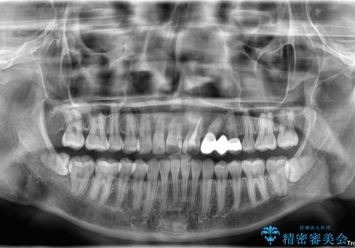全体的なデコボコが気になる。拡大装置を併用したワイヤー矯正の治療後