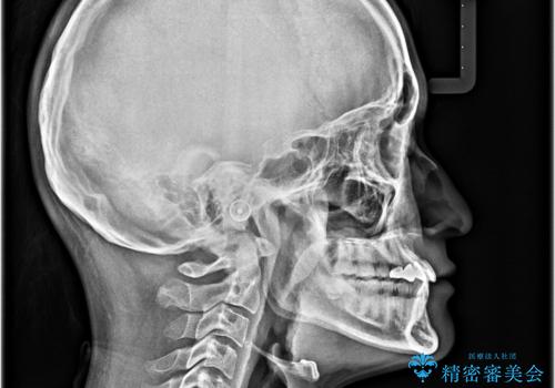 全体的なデコボコが気になる。拡大装置を併用したワイヤー矯正の治療後