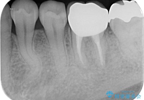 汚れの溜まりやすい銀歯を精度の高いセラミック治療で改善の治療後