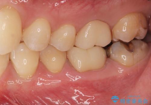 汚れの溜まりやすい銀歯を精度の高いセラミック治療で改善の治療後