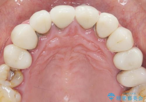 [ 審美歯科 ] 前歯セラミック治療の再治療の治療前