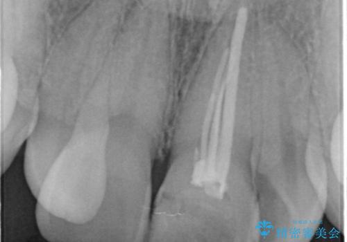 前歯の見た目が気になる。の治療前