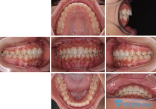 気になるすきっ歯を短期間で改善　インビザライン矯正の治療後