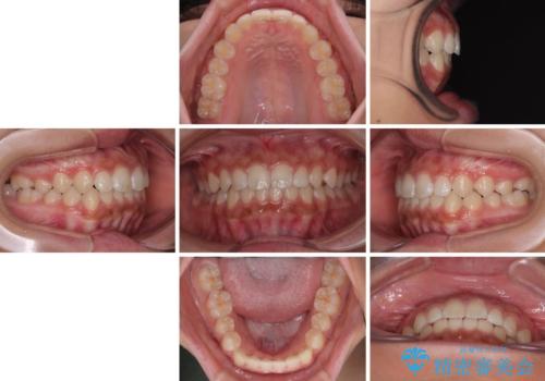 気になるすきっ歯を短期間で改善 インビザライン矯正の治療後