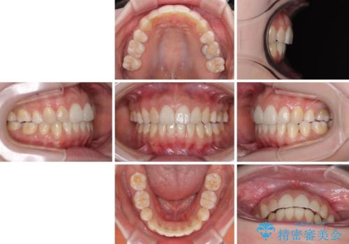 後戻りをインビザラインでスッキリした口元にの治療後