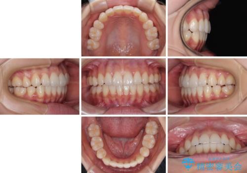 抜歯矯正の軽度後戻りを解消 インビザライン矯正の治療後