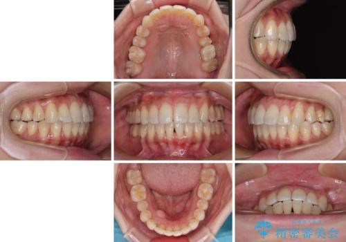 インビザラインによる矯正治療と奥歯のインプラント治療の治療後
