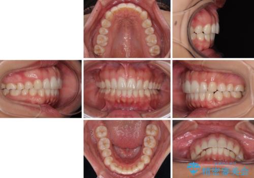 【モニター】突出した前歯 補助装置を併用したインビザライン矯正の治療後