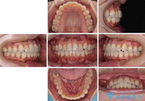 前歯のクロスバイト インビザラインによる矯正治療の治療後