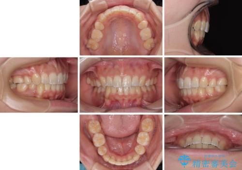 八重歯と上顎前突 ワイヤー装置での抜歯矯正の治療後